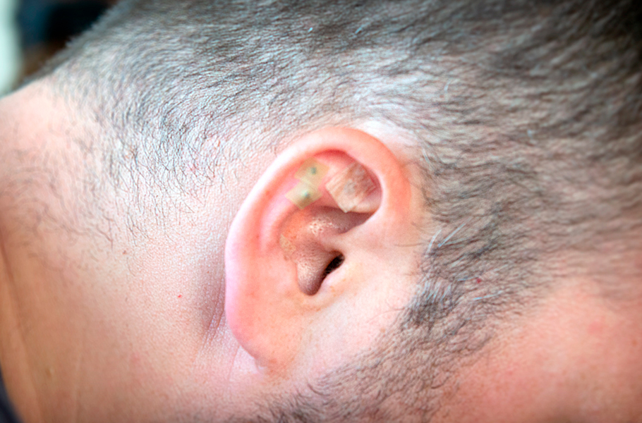 Akupunkturní jehly v uchu